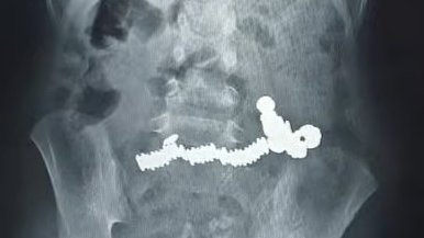 5-year-old child saved in Sharjah after swallowing 52 magnets